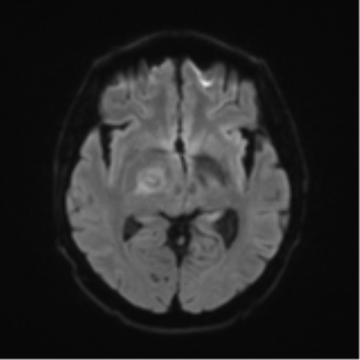 Cerebral toxoplasmosis (Radiopaedia 54575-60804 Axial DWI 48).png