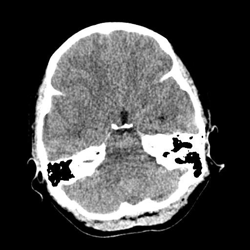 Cerebral tuberculosis with dural sinus invasion (Radiopaedia 60353-68018 Axial non-contrast 14).jpg