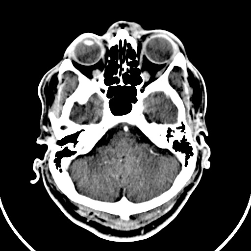 File:Cerebral venous angioma (Radiopaedia 69959-79977 B 6).jpg
