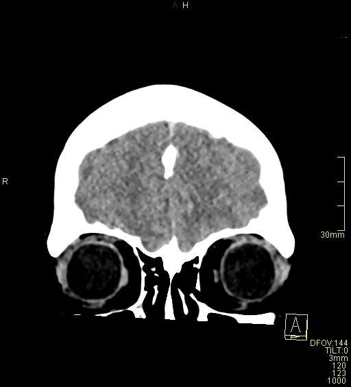 Cerebral venous sinus thrombosis (Radiopaedia 91329-108965 Coronal non-contrast 8).jpg