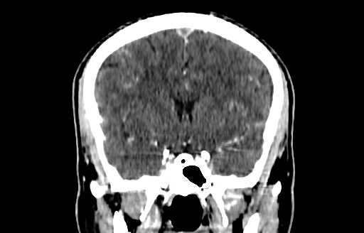 Cerebral venous thrombosis (CVT) (Radiopaedia 77524-89685 C 25).jpg