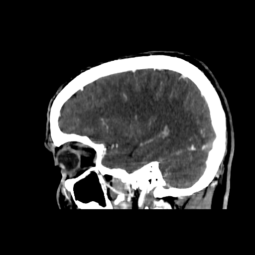 File:Cerebral venous thrombosis (CVT) (Radiopaedia 77524-89685 Sagittal CTV 10).jpg