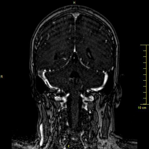 Cerebral venous thrombosis (Radiopaedia 23288-23351 MRV 113).JPG