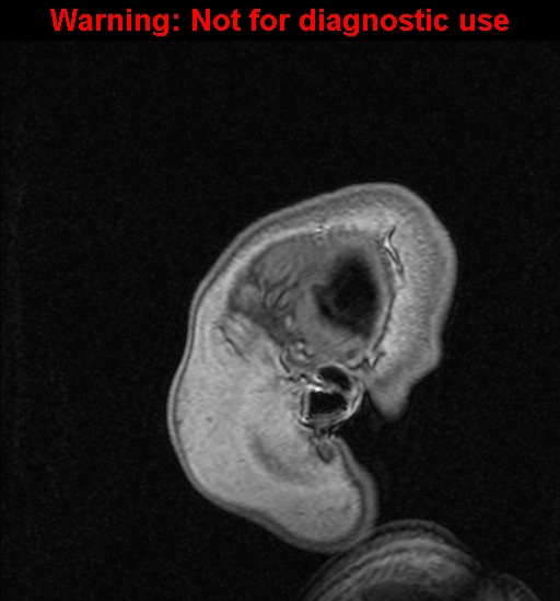 File:Cerebral venous thrombosis (Radiopaedia 37224-39208 Sagittal T1 C+ 6).jpg