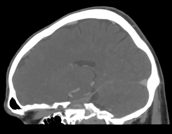 File:Cerebral venous thrombosis (Radiopaedia 38392-40467 D 32).png