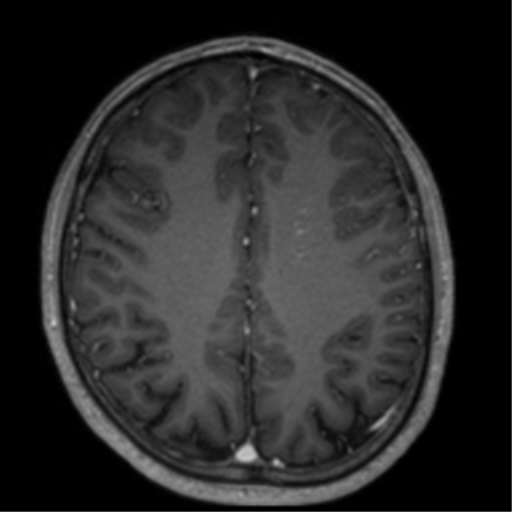 Cerebral venous thrombosis (Radiopaedia 38392-40469 Axial T1 C+ 54).png