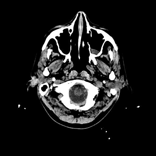 File:Cerebral venous thrombosis with venous hemorrhagic infarct (Radiopaedia 90354-107660 Axial non-contrast 5).jpg