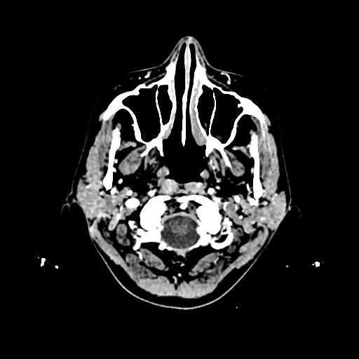 Cerebral venous thrombosis with venous hemorrhagic infarct (Radiopaedia 90354-107660 Axial with contrast 7).jpg