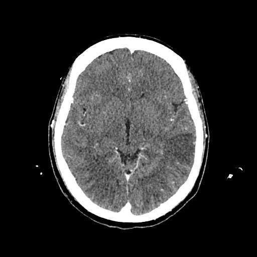 Cerebral venous thrombosis with venous hemorrhagic infarct (Radiopaedia 90354-107660 Axial with contrast 79).jpg