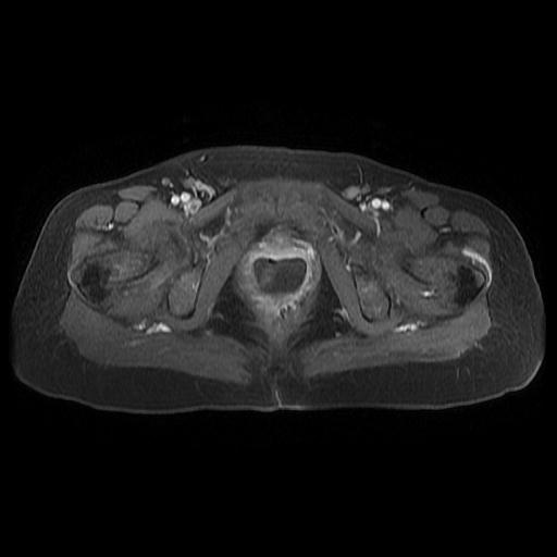 File:Cervical carcinoma (Radiopaedia 67644-77047 Axial T1 C+ fat sat 17).jpg