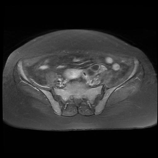 File:Cervical carcinoma (Radiopaedia 88010-104555 Axial T1 C+ fat sat 4).jpg