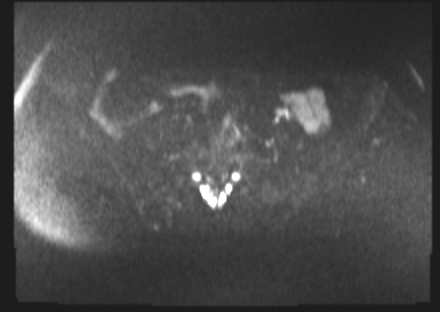 File:Cervical carcinoma (Radiopaedia 88312-104943 Axial DWI 5).jpg