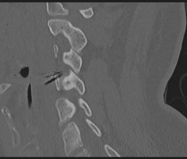 Cervical disc replacement (Radiopaedia 44025-47541 Sagittal bone window 34).png