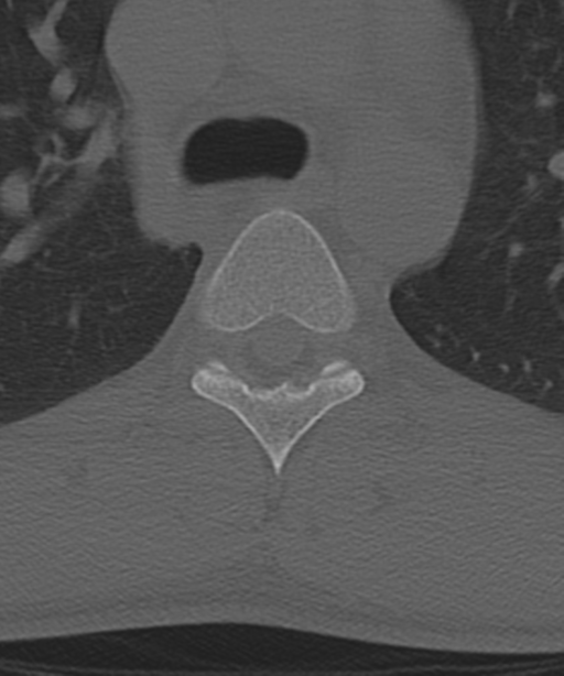 Cervical intercalary bone (Radiopaedia 35211-36748 Axial bone window 83).png