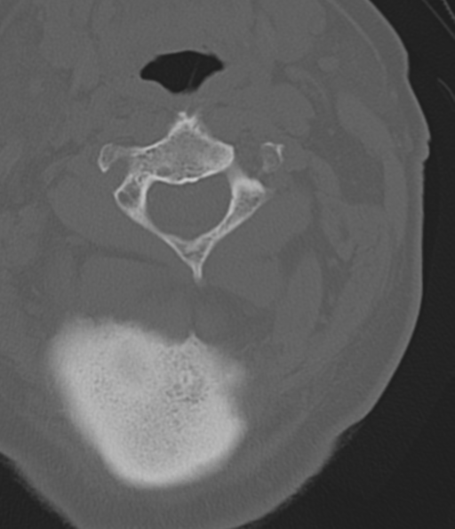 File:Cervical spine fracture in the setting of ankylosis (Radiopaedia 37038-38715 Axial bone window 19).png