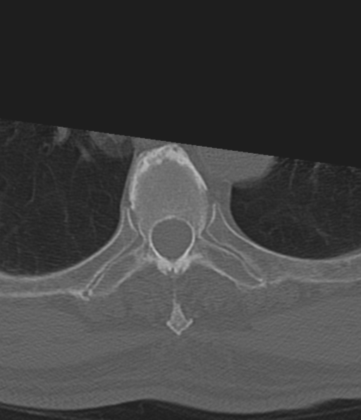 File:Cervical spine fracture in the setting of ankylosis (Radiopaedia 37038-38715 Axial bone window 77).png