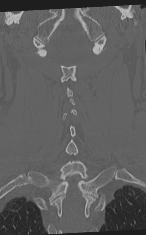 Cervical spine fractures with vertebral artery dissection (Radiopaedia 53296-59268 Coronal bone window 47).png
