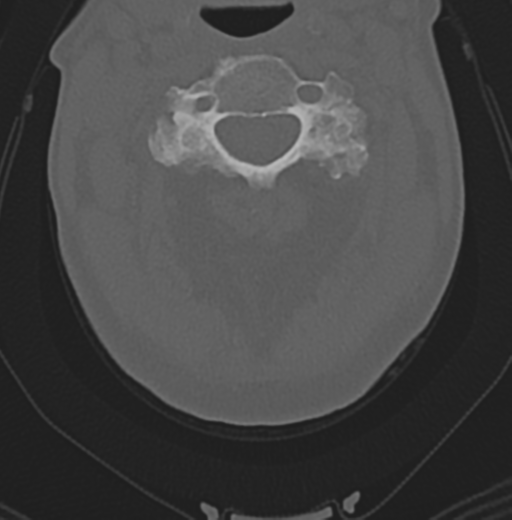 Cervical spondylolysis (Radiopaedia 49616-54811 Axial bone window 22).png