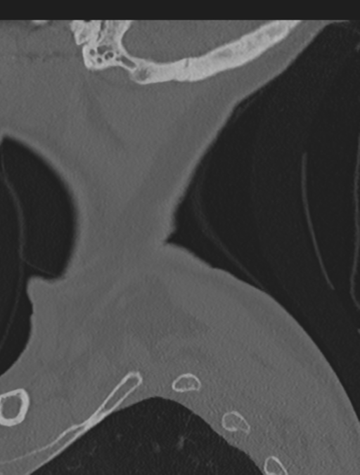 Cervical spondylolysis (Radiopaedia 49616-54811 Sagittal bone window 3).png