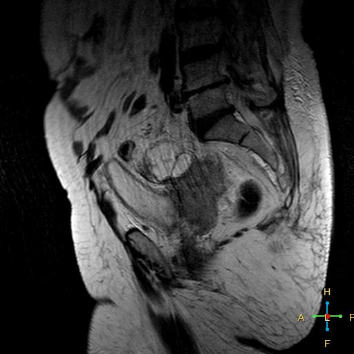 File:Cervical stump squamous cell carcinoma (Radiopaedia 48049-52858 Sagittal T2 10).jpg