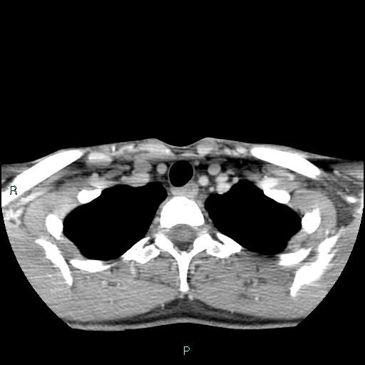 Cervical thymic cyst (Radiopaedia 88632-105335 C 28).jpg