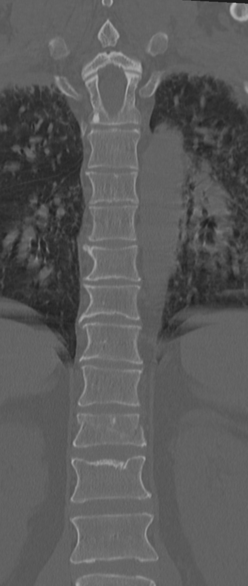 Chance fracture (Radiopaedia 33854-35020 Coronal bone window 44).png