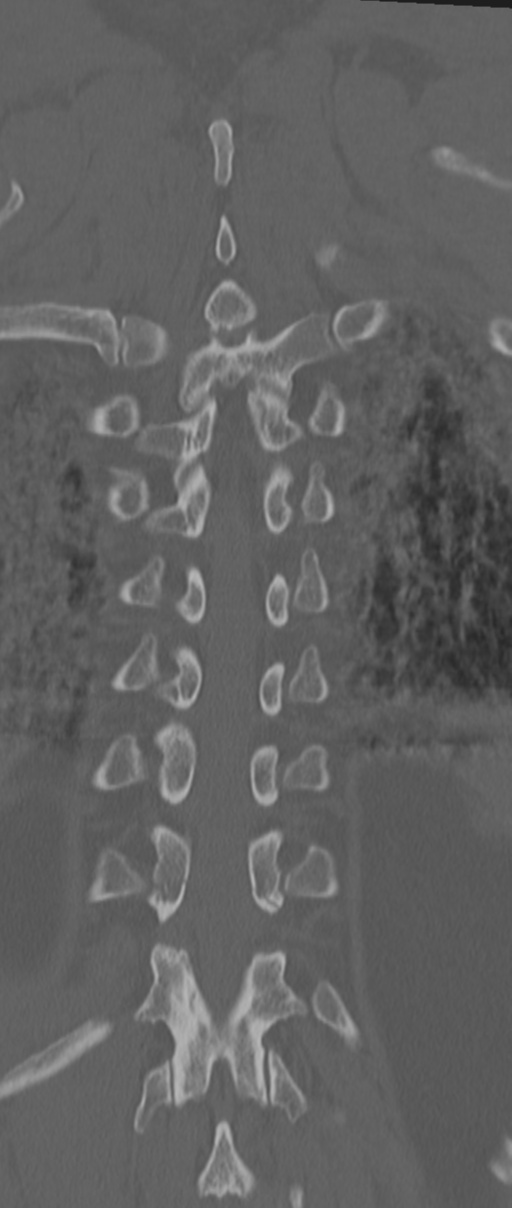 Chance fracture (Radiopaedia 33854-35020 Coronal bone window 65).png