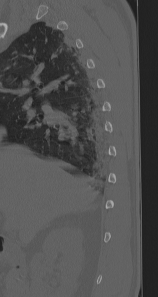 Chance fracture (Radiopaedia 33854-35020 Sagittal bone window 77).png