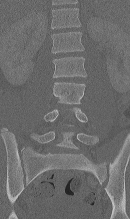Chance fracture (Radiopaedia 40360-42912 Coronal bone window 32).png