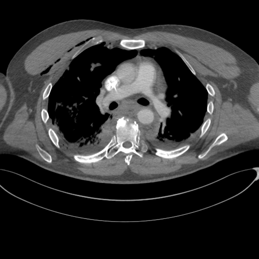 File:Chest multitrauma - aortic injury (Radiopaedia 34708-36147 A 132).png