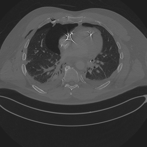Chest multitrauma - aortic injury (Radiopaedia 34708-36147 Axial bone window 176).png