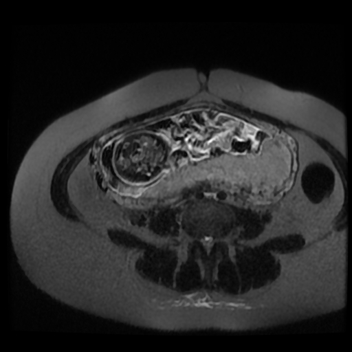 Chiari II malformation - fetal MRI (Radiopaedia 68099-77581 Axial T2-SSFSE 16).jpg