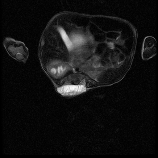 File:Chiari II malformation with spinal meningomyelocele (Radiopaedia 23550-23652 Axial T2 10).jpg