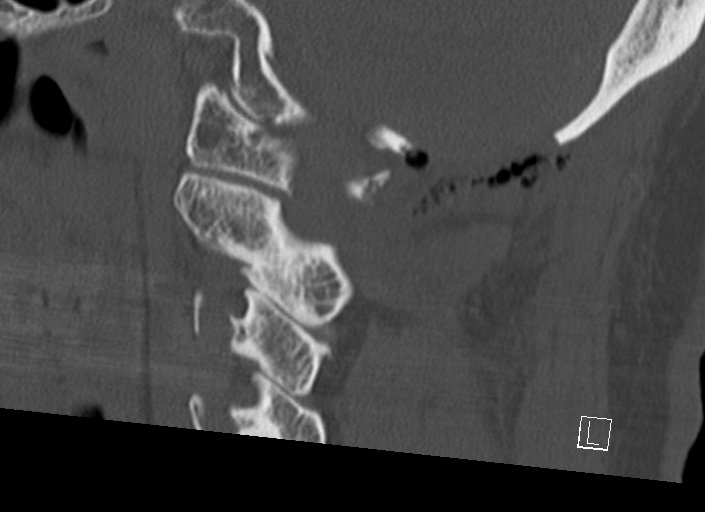 Chiari I malformation with a symptomatic syrinx of the posterolateral medulla oblongata (Radiopaedia 42573-45707 A 37).jpg