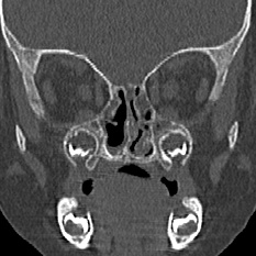 Choanal atresia (Radiopaedia 88525-105975 Coronal bone window 51).jpg