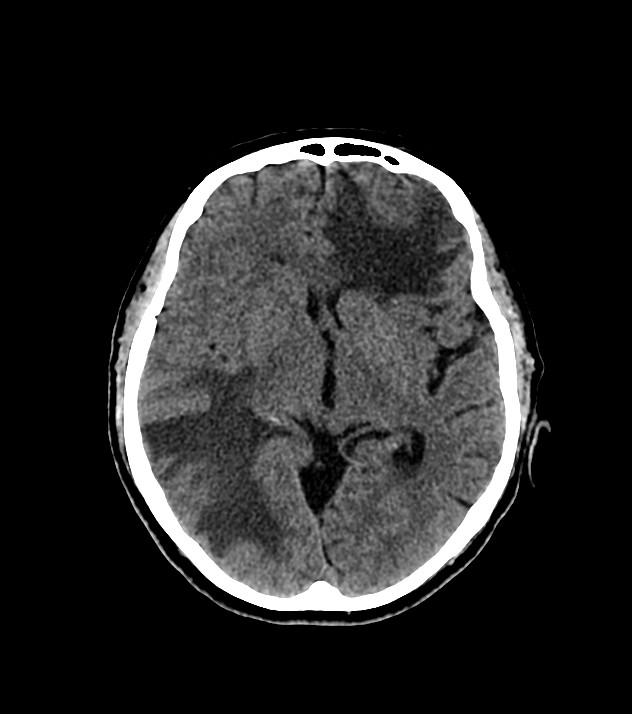 Cholangiocarcinoma with cerebral metastases (Radiopaedia 83519-98628 Axial non-contrast 34).jpg
