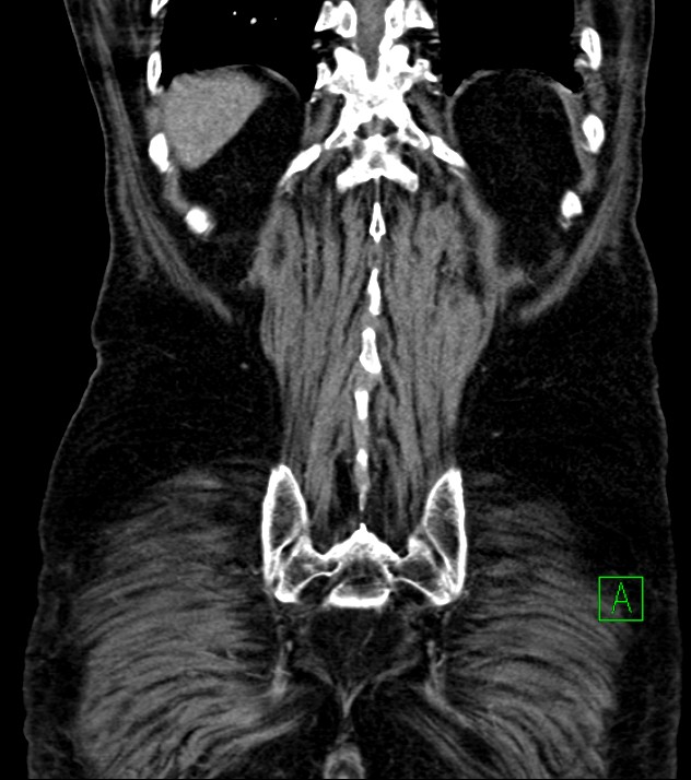 Cholangiocarcinoma with cerebral metastases (Radiopaedia 83519-98629 E 74).jpg