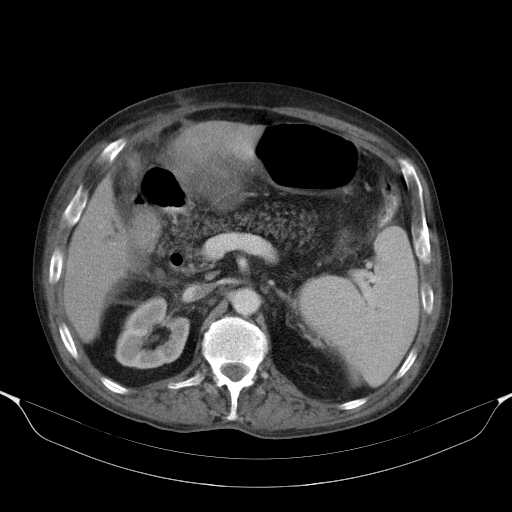 File:Cholangitis and abscess formation in a patient with cholangiocarcinoma (Radiopaedia 21194-21100 A 19).jpg