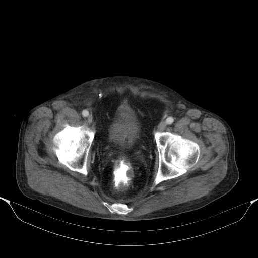 File:Cholangitis and abscess formation in a patient with cholangiocarcinoma (Radiopaedia 21194-21100 A 46).jpg