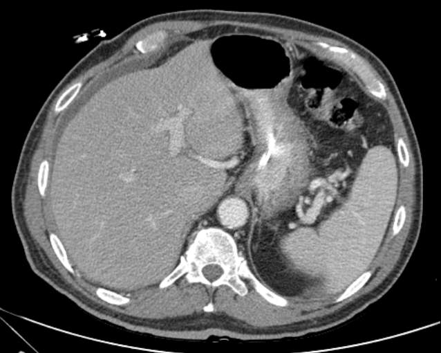 File:Cholecystitis - perforated gallbladder (Radiopaedia 57038-63916 A 19).jpg