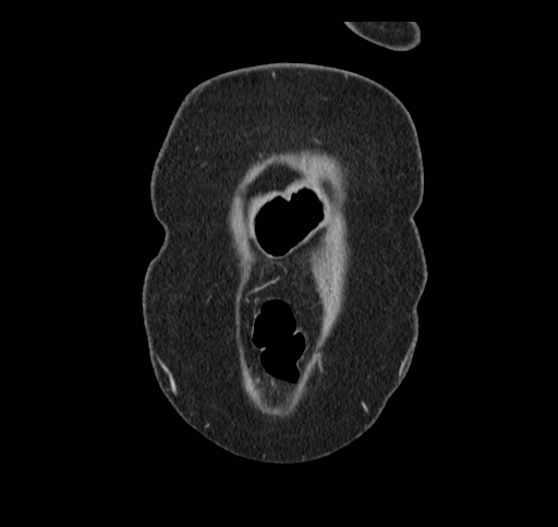 Cholecystoduodenal fistula (Radiopaedia 48959-54022 B 10).jpg