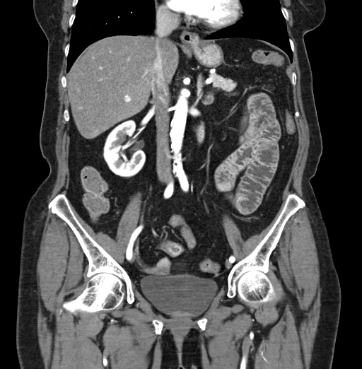 File:Cholecystoduodenal fistula due to calculous cholecystitis with gallstone migration (Radiopaedia 86875-103077 B 24).jpg