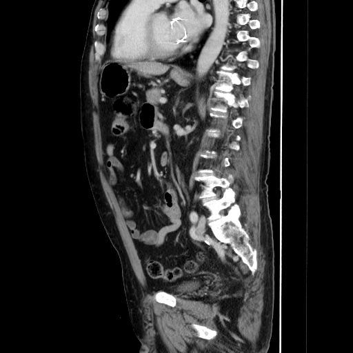 Choledocholiathiasis with normal caliber common bile duct (Radiopaedia 75368-86632 D 97).jpg
