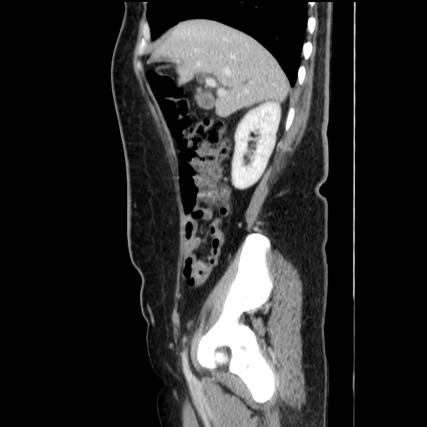 Choledocholithiasis on CT and MRI (Radiopaedia 24825-25087 D 20).jpg