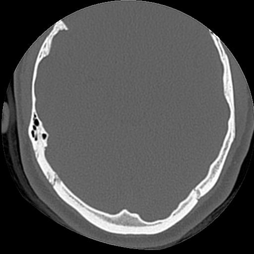 Cholesteatoma (Radiopaedia 84960-100474 Axial bone window 17).jpg