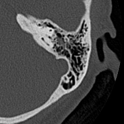 File:Cholesteatoma of the external ear (Radiopaedia 16540-16225 Axial bone window 14).jpg