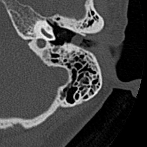 File:Cholesteatoma of the external ear (Radiopaedia 16540-16225 Axial bone window 23).jpg