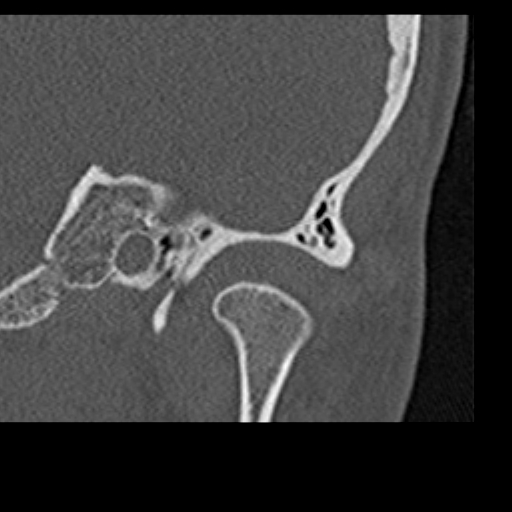 File:Cholesteatoma of the external ear (Radiopaedia 16540-16225 Coronal bone window 2).jpg