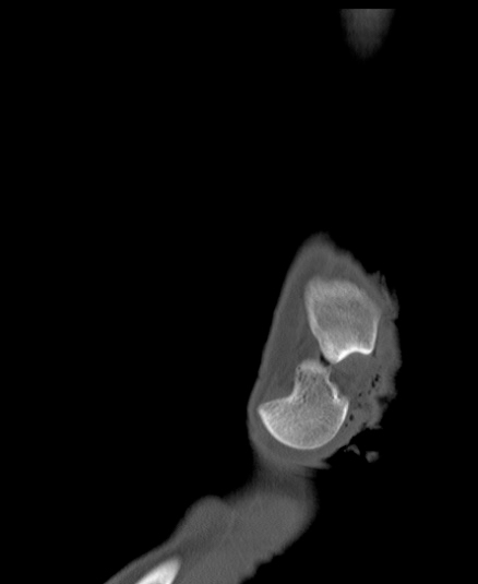 Chopart fracture (Radiopaedia 35347-36851 Sagittal bone window 18).jpg