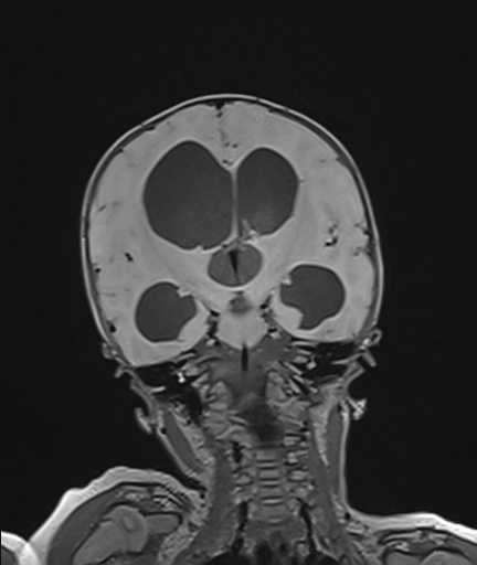 Choroid plexus papilloma (Radiopaedia 84612-100019 Coronal FLAIR 66).jpg